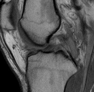 PCL completely torn